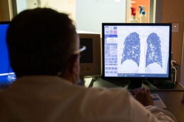 Des chercheurs de Porto développent une méthode non invasive pour diagnostiquer le cancer du poumon