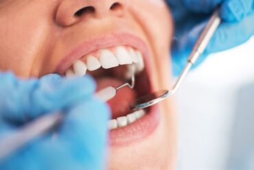 Mauvaise hygiène bucco-dentaire liée à 23 maladies systémiques, cinq types de cancer