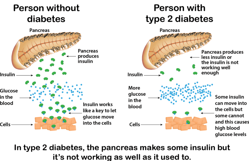 Des scientifiques portugais découvrent un lien entre le diabète II et la maladie de Parkinson